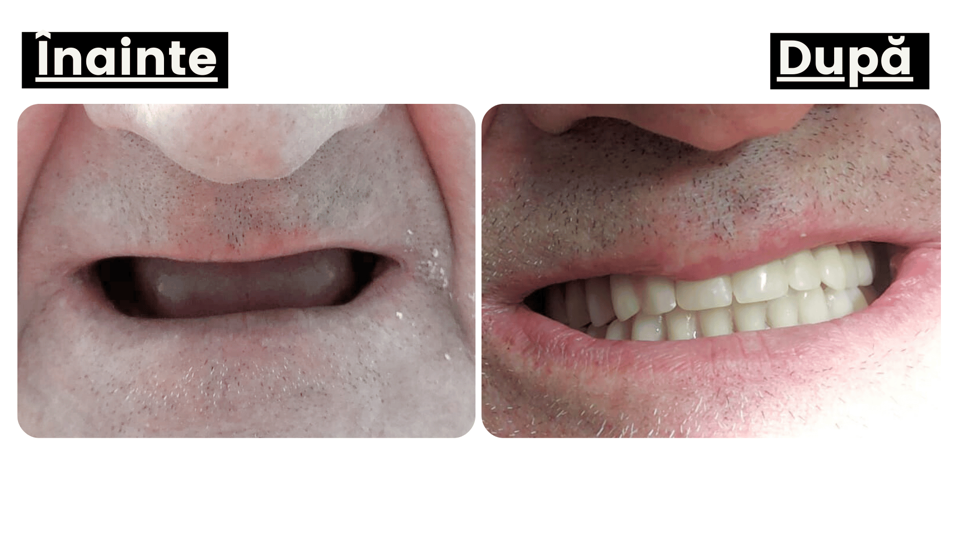 Proteză mobilă sau proteză fixă